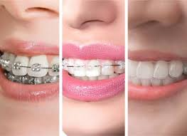 Braces and aligners treatment options