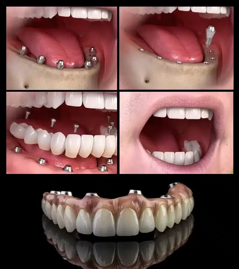 Dental implant treatment