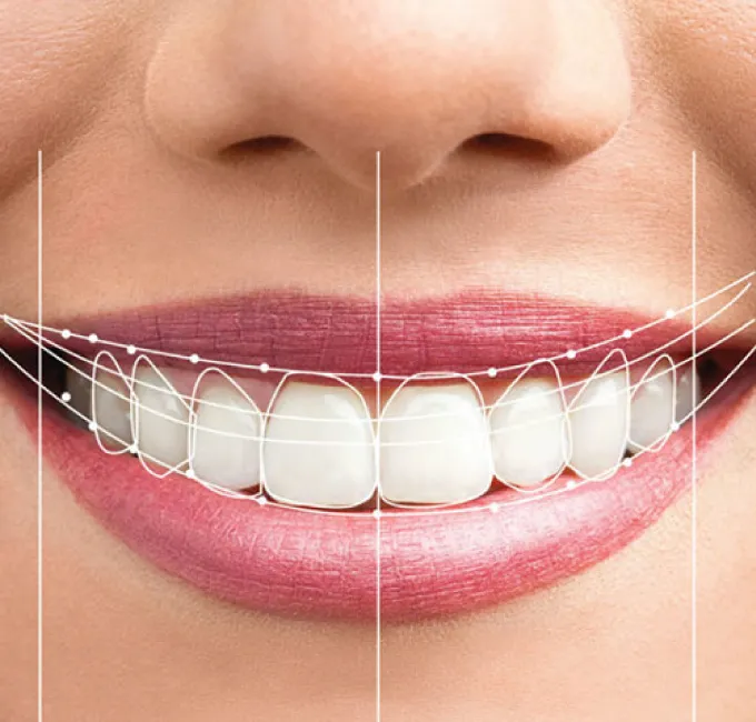 Smile makeover results